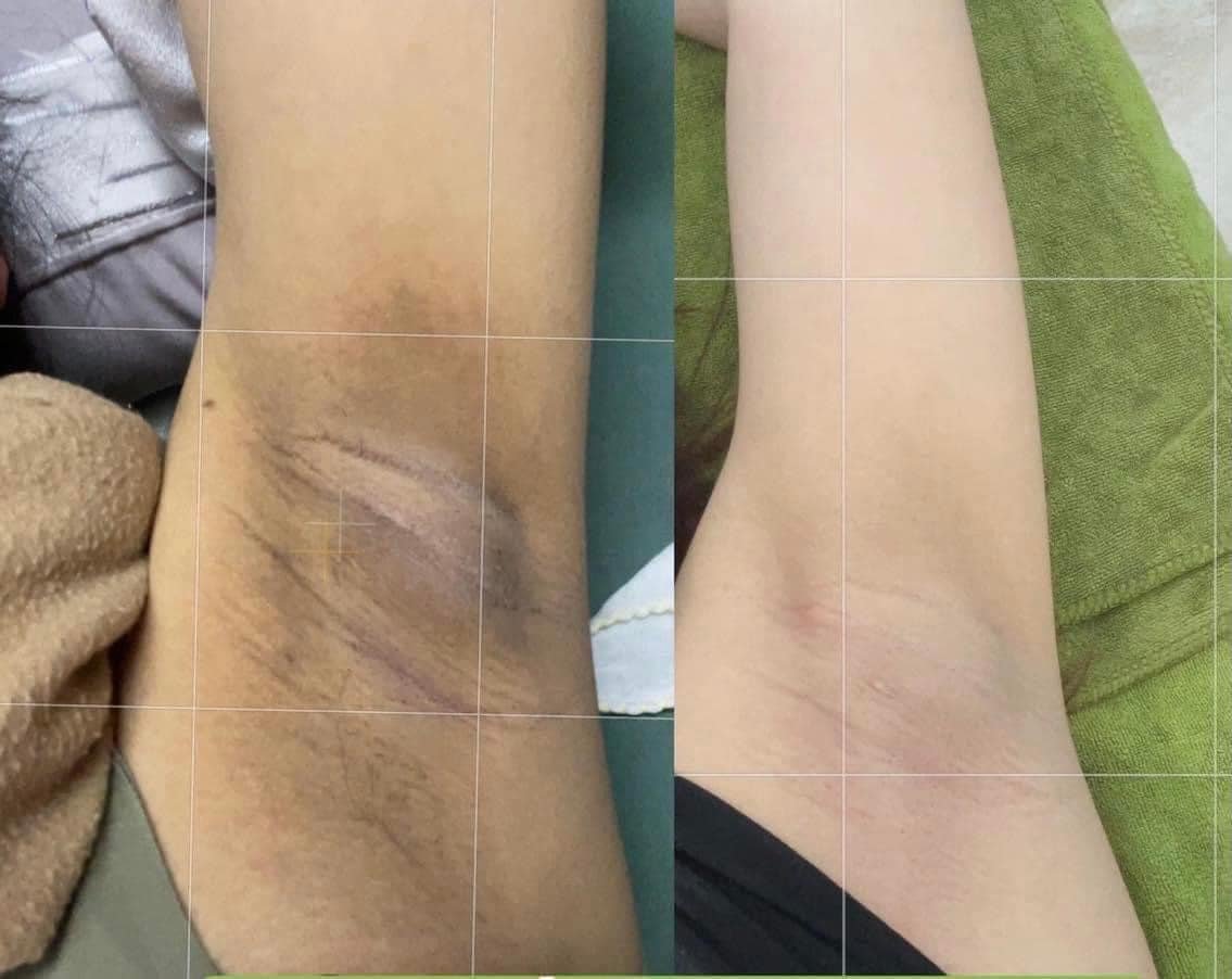 Kem Giảm Thâm Nách Q Nic Care Thái Lan Phiên Bản Mới