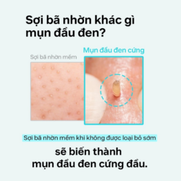 Combo Tinh Chất Ủ Mụn Đầu Đen 150g + Cây Đẩy Mụn Đầu Đen ILSO Giúp Sạch Bã Nhờn Sáng Da - ILSO02