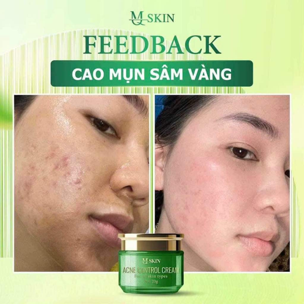 Cao Mụn Sâm Vàng MQ Skin 20g