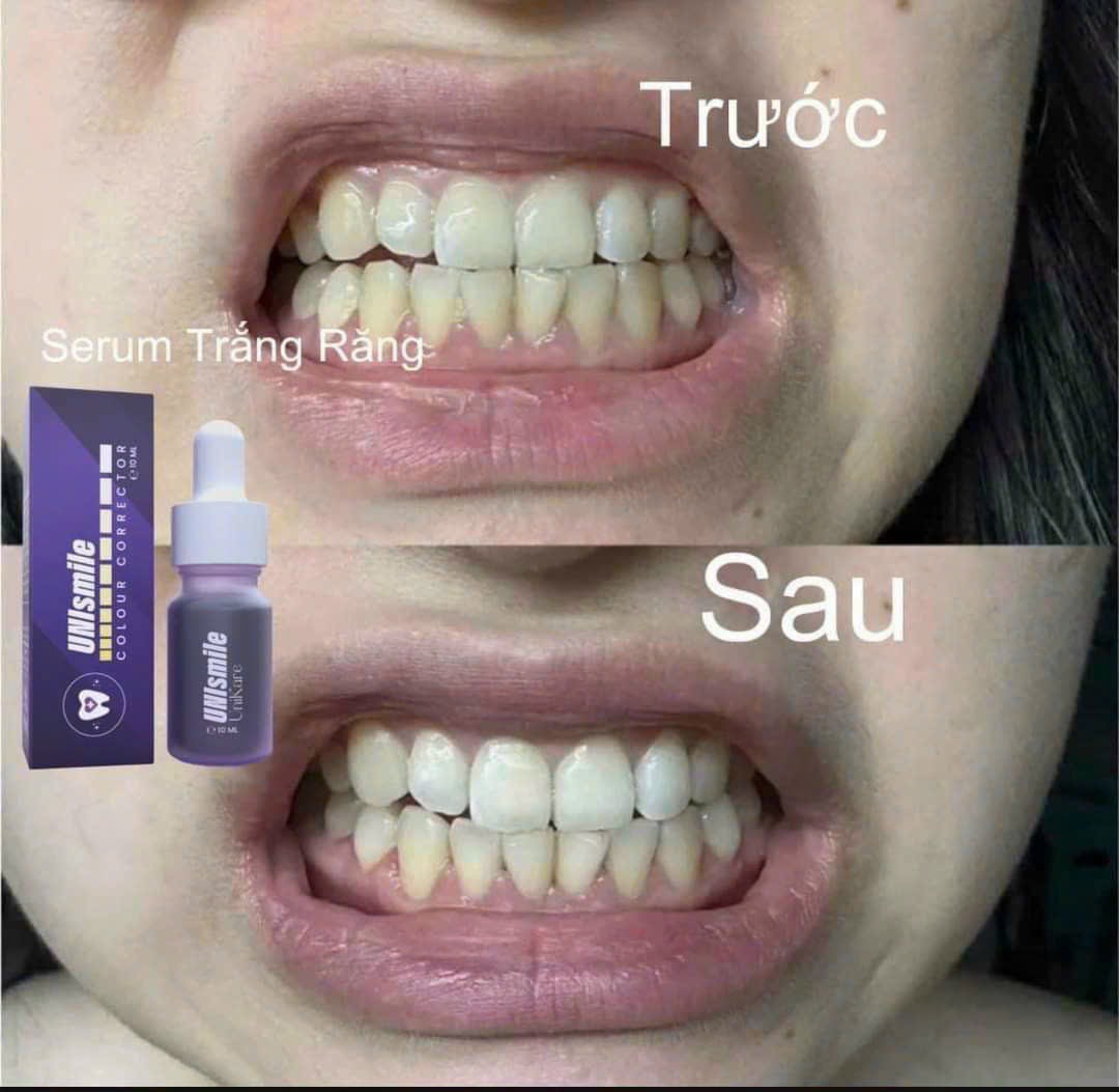 Serum Trắng Răng Unismile, Hỗ Trợ Cải Thiện Vết Ố Vàng Unikare